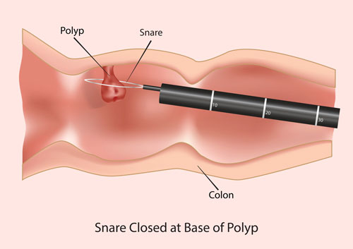 polyp_removed